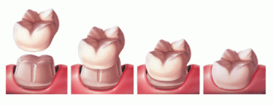 چه دندان‌هایی باید روکش شوند؟
