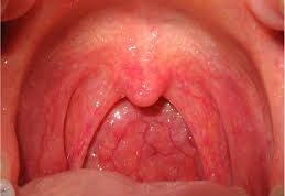 واکنش غیر طبیعی مخاط دهان به آنتی‌ژن‌ها، راه‌های تشخیص و روش‌های درمان