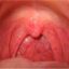 واکنش غیر طبیعی مخاط دهان به آنتی‌ژن‌ها، راه‌های تشخیص و روش‌های درمان