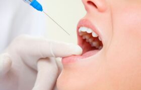 همه‌چیزهایی که می‌خواهید درباره بی‌حسی دندانپزشکی بدانید