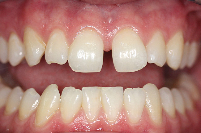 جابجا‌شدن غیرطبیعی دندان‌ها؛ بیماری ایام میان‌سالی