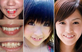رمزگشایی از یک مد تازه در ژاپن: چرا دختران ژاپنی دندان‌های خود را شبیه خون‌آشام می‌کنند؟