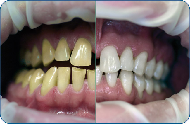 ۱۲+۱نکته درباره بلیچینگ (سفیدکردن) دندان‌ها به روش خانگی