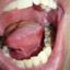 سرطان دهان؛ ارثی است یا محیطی؟