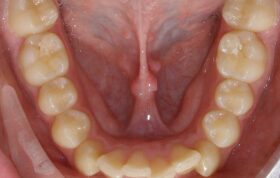 آیا رویش دندان عقل در بی‌نظمی دندان‌های قدامی نقش دارد؟