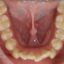 آیا رویش دندان عقل در بی‌نظمی دندان‌های قدامی نقش دارد؟