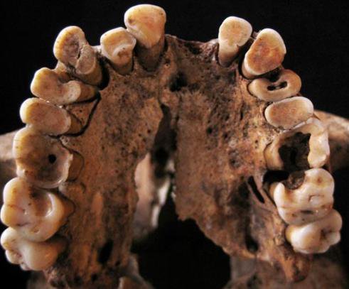 انسان‌های اولیه هم دندان درد داشتند!