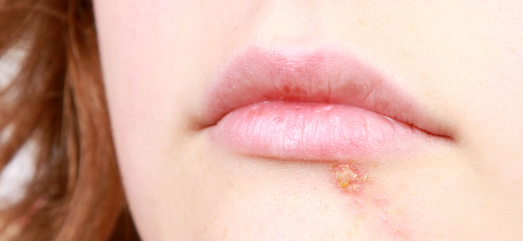 همه چیزهایی که می‌خواهید درباره تبخال بدانید