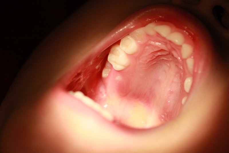 اولین دندان آسیای بزرگ و اهمیت آن در دهان کودکان