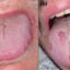 تظاهرات سه‌گانه دهانی غالب در بیماران مبتلا به کووید ۱۹