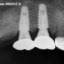 سنسور دیجیتال رادیوگرافی RVG Xray Genoray PORTVIEW Digital Intra-Oral Sensor دندانپزشکی