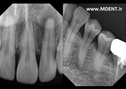 سنسور دیجیتال رادیوگرافی RVG Xray Genoray PORTVIEW Digital Intra-Oral Sensor دندانپزشکی