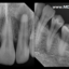 سنسور دیجیتال رادیوگرافی RVG Xray Genoray PORTVIEW Digital Intra-Oral Sensor دندانپزشکی