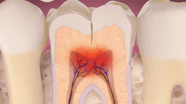 تفاوت دیدگاه دندانپزشکان عمومی و متخصص در درمان دندان‌های ترک خورده