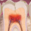 تفاوت دیدگاه دندانپزشکان عمومی و متخصص در درمان دندان‌های ترک خورده