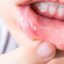 بررسی سیستماتیک ضایعات مخاطی دهانی در بیماران مبتلا به کووید ۱۹