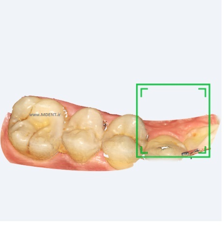 اسکنر-داخل-دهانی-شاینینگ-Shining-3D-مدل-AoralScan 3 
